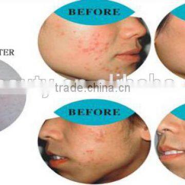 AYJ-Y71A CE Acne Treatment Skin Care Acne Clear Removal Machine photo-2