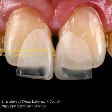 Ultra-thin dental veneers, porcelain veneer, dental laminates, laboratoire dentaire, Dentallabor, laboratorio dental, dental laboratory, Shenzhen LJ dental lab China