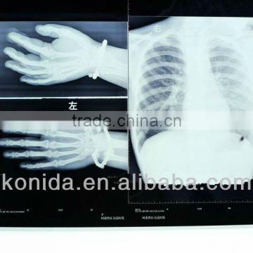 medical diagnostic x-ray equipment,medical blue paper,konida laser printer