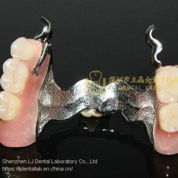 Dental Precision Attachment, Dental Attachment, Dental Denture, Laboratoire Dentaire, Dentallabor, Laboratorio Dental, Dental Laboratory, Shenzhen LJ Dental Lab China photo-5