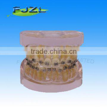 orthodontic teeth model(Transparent model , dislocation tooth, common brackets),dental orthodontic models