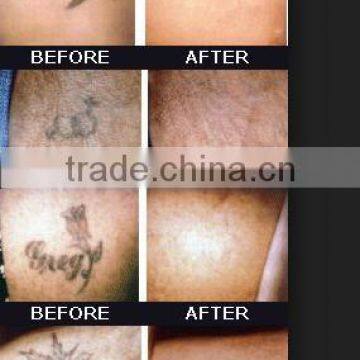 CE Approved Nd Yag Q-switched Brown Age Spots Removal Laser Tattoo Removal Machine/long Pulse/1064nm&532nm Naevus Of Ota Removal photo-2