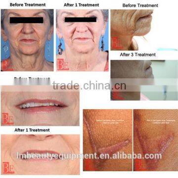 Fractional Radiofrequency Micro Needles for Permanent Makeup photo-6