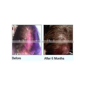 Hair Growth Diode Laser / Hair Growth Laser/ Diode Laser Hair Growth / Hair Loss Treatment