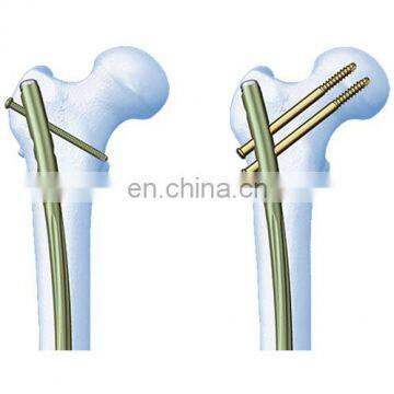 Femoral Intramedullary Nail Set photo-2