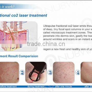 30W RF Mental Tube CO2 Laser Portable Fractional Acne Scar Removal Machine Professional photo-4