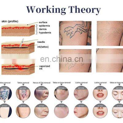 Latest Technology Equipment 808nm Laser Diode Price Tattoo Removal Machine for Beauty Salon photo-5