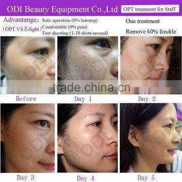 No Pain Optimal Pulse Technology OPT Multi-functional Shr Best Professional Ipl Machine Vascular Removal For Beauty Salon Equipment Shr Ipl Hair Removal Whitening Skin Age Spots Removal photo-6