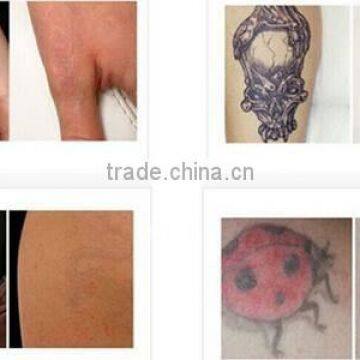 2016 Newest High Quality Portable Nd Yag Laser (532 Nm) Tattoo Removal Machine With Manufacturing Price Beauty Equipment