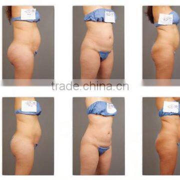 Skin Rejuvenation Ultrashape Slimming HIFU/Ultrasonix Body Back Tightening Fat Loss/Ultrashape Slimming Machine