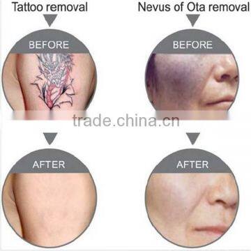 Professional Q-switch ND:YAG Laser Tattoo Removal Beauty Salon Equipment photo-2
