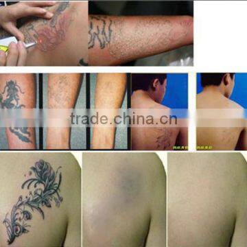 Q Switched Laser Machine Venus Laser Hair Removal E-light Ipl Naevus Of Ota Removal Rf+nd Yag Laser Multifunction Machine Laser Epilation photo-6