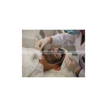 Q Switch Nd Yag Pigmented Lesions Treatment Laser Price 1064nm &532nm Wavelength Laser Removal Tattoo Machine