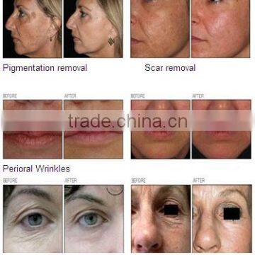 Fractional Co2 Laser Vaginal Tightening / Co2 Laser rf photo-3