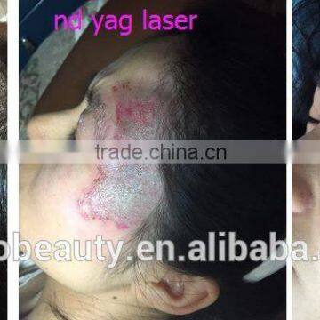 Malaysia Best q Switched nd Yag Laser Tattoo Removal Equipment Price photo-6