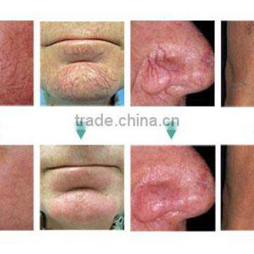 Pain Free Skin Mole Removal Machine photo-4