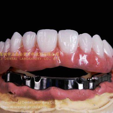 Dental Implant Bar, Implant Overdenture, Implant Prosthesis, Laboratoire Dentaire, Dentallabor, Laboratorio Dental, Dental Laboratory, Shenzhen LJ Dental Lab China photo-3