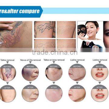 CE Approved Imported Laser Bar nd Yag Laser Tattoo Removal Skin Whitening Treatment photo-6