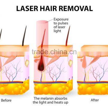Home Use Potable 808nm Diode Laser Epilator Home Laser Hair Removal photo-6