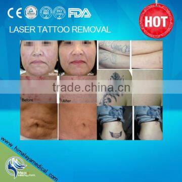 Haemangioma Treatment Laser Tatoo Remove Machine Laser Tattoo Machine Beauty Equipment 532nm photo-6