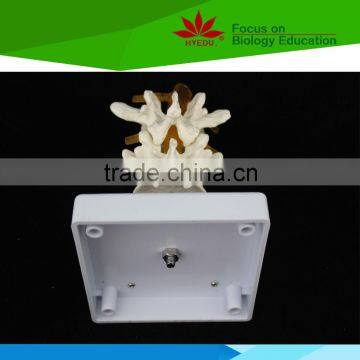 High Quality for Medical Educational Supply 2 Lumbar Vertebrae Skeleton Model With Hernia and Prolapsed Intervertebral Disc
