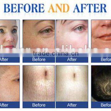 Derma Rollers For Acne Scars Body Dermaroller Derma Rolling Microneedles For Face System Derma Equipment 2.5mm photo-4