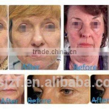 Skin Tightening HIFU-C Hifu Focused Ultrasound 300W Portable Wrinkle Removal Machine