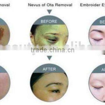 New Portable Tattoo Removal Laser Machine For Brown Age Spots Removal Sale/Long Pulse Nd Yag Laser Tattoo Removal 800mj