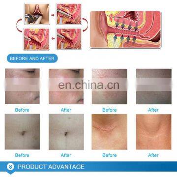 LEFIS 10600nm Laser Co2 Vegina Tightening Factional Co2 Machine photo-6