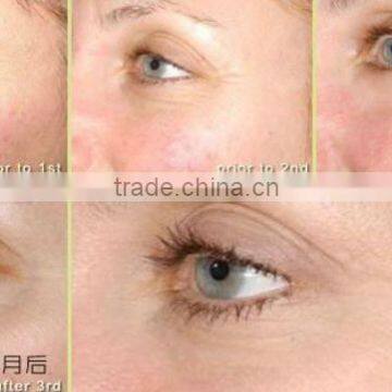 Iontophoresis Machine Australia Anti Wrinkle Pen Under Eye Wrinkles Eraser photo-6