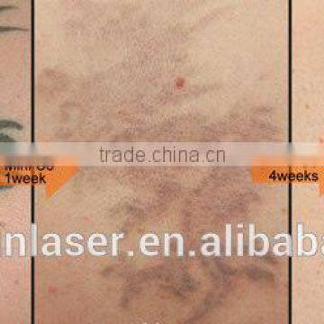 ND Yag Laser Tattoo Removal Machine Vascular Tumours Treatment Mini Q Switch ND Yag Laser MINI-C6 Tattoo Laser Removal Machine photo-5