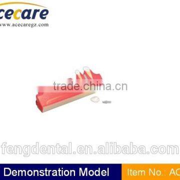 dental supply implant demonstration model HOT AC-P15