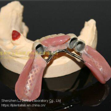Dental Telescope Denture, Telesope Crown, Dental Prosthesis, Laboratoire Dentaire, Dentallabor, Laboratorio Dental, Dental Laboratory, Shenzhen LJ Dental Lab China photo-4