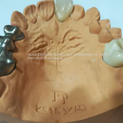 3d print PFM denture & false teeth