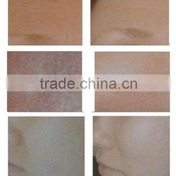 Eye Wrinkle / Bag Removal Professional Portable Co2 FDA Approved Laser Warts Removal Tube/co2 Fractional Laser Machine 0.1mj-300mj photo-6