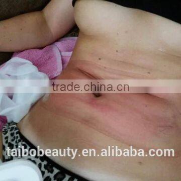 Fat Reduction Greece Hot Sell Best Cryolipolysis Fat Freezing Machine For Sale Body Shaping photo-5