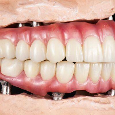 Elite PFM (Porcelain Fused To Metal A Professional Outsourcing dental lab