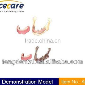 Hot sale and high quality implant model of the lower jaw AC-P12