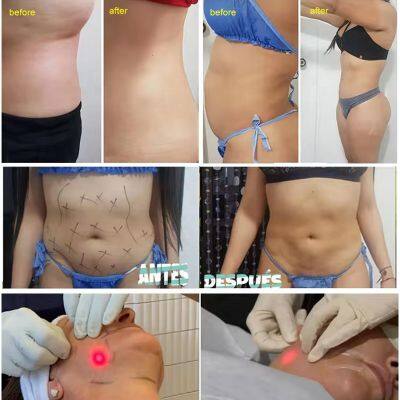 Portable Endolaser Machine Liposuction Fat Burning 1470NM Laser Slimming With CE photo-2