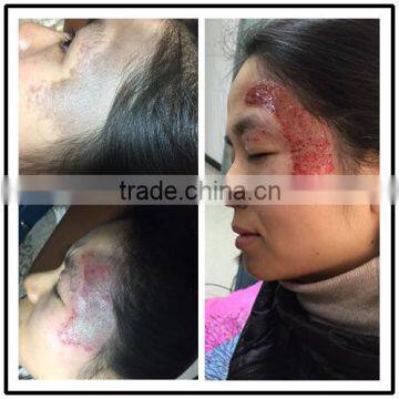 Professional Tattoo Anesthetic Tattoo Machines Q-Switch ND Yag Laser Machine For Laser Tattoo Removal or Birthmark Removal photo-6