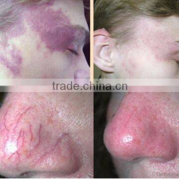 MBT 980nm Diode Laser for Vascular Lesions and Spider Veins Machine photo-6