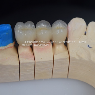 Zirconia High Translucent  CROWNS & BRIDGES ZIRCONIA HT (HIGH TRANSLUCENT) Zirconia High Translucent - All Ceramic Dental Crowns & Bridge CROWNS & BRIDGES | ALL CERAMICS