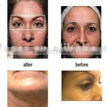 No-needle rf Skin Instrument for Facial Care Wrinkle Removal and Skin Tightening Whitening photo-4