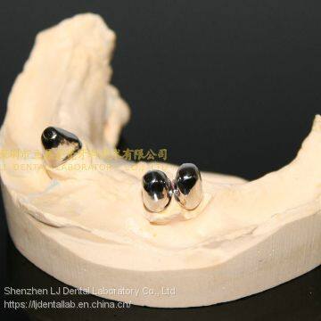 Dental Telescope Denture, Telesope Crown, Dental Prosthesis, Laboratoire Dentaire, Dentallabor, Laboratorio Dental, Dental Laboratory, Shenzhen LJ Dental Lab China photo-2