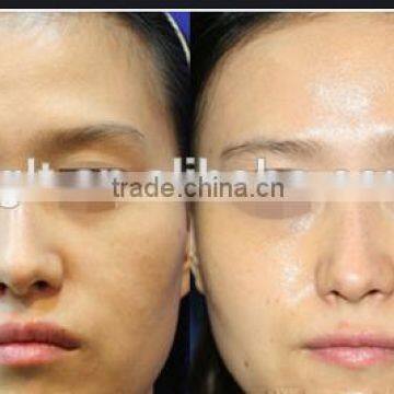 Best no Needle Cooling RF Skin Beauty Machine for Home Use photo-5