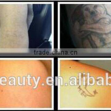 Mongolian Spots Removal China Factory Provide Cheapest Tattoo Removal System Yag Laser Tattoo Removal Machine Permanent Tattoo Removal