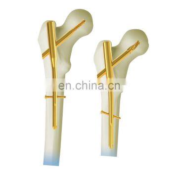 Titanium Intramedullary Nails.PFNA.PFNA Nail photo-2