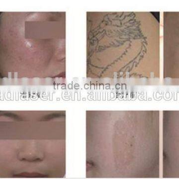 Best Q-switched Nd: Yag Laser photo-6