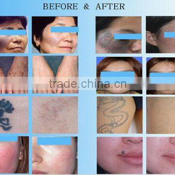 Q-switch Nd Yag Laser Skin Care Tattoo Removal Laser Medical Hospital Spa Equipment by Taibo Beauty Company