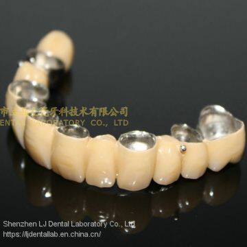 Dental Crown Composite, Dental Teeth, Dental Prosthesis, Laboratoire Dentaire, Dentallabor, Laboratorio Dental, Dental Laboratory, Shenzhen LJ Dental Lab China photo-2